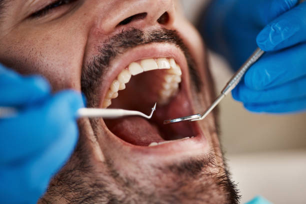 Best Emergency Wisdom Tooth Extraction in Westminster, CA